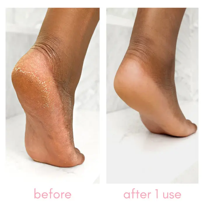 Heel-ing Callus Remover - Image 2