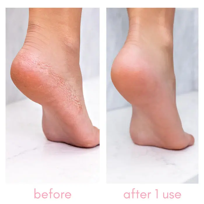 Heel-ing Callus Remover - Image 4