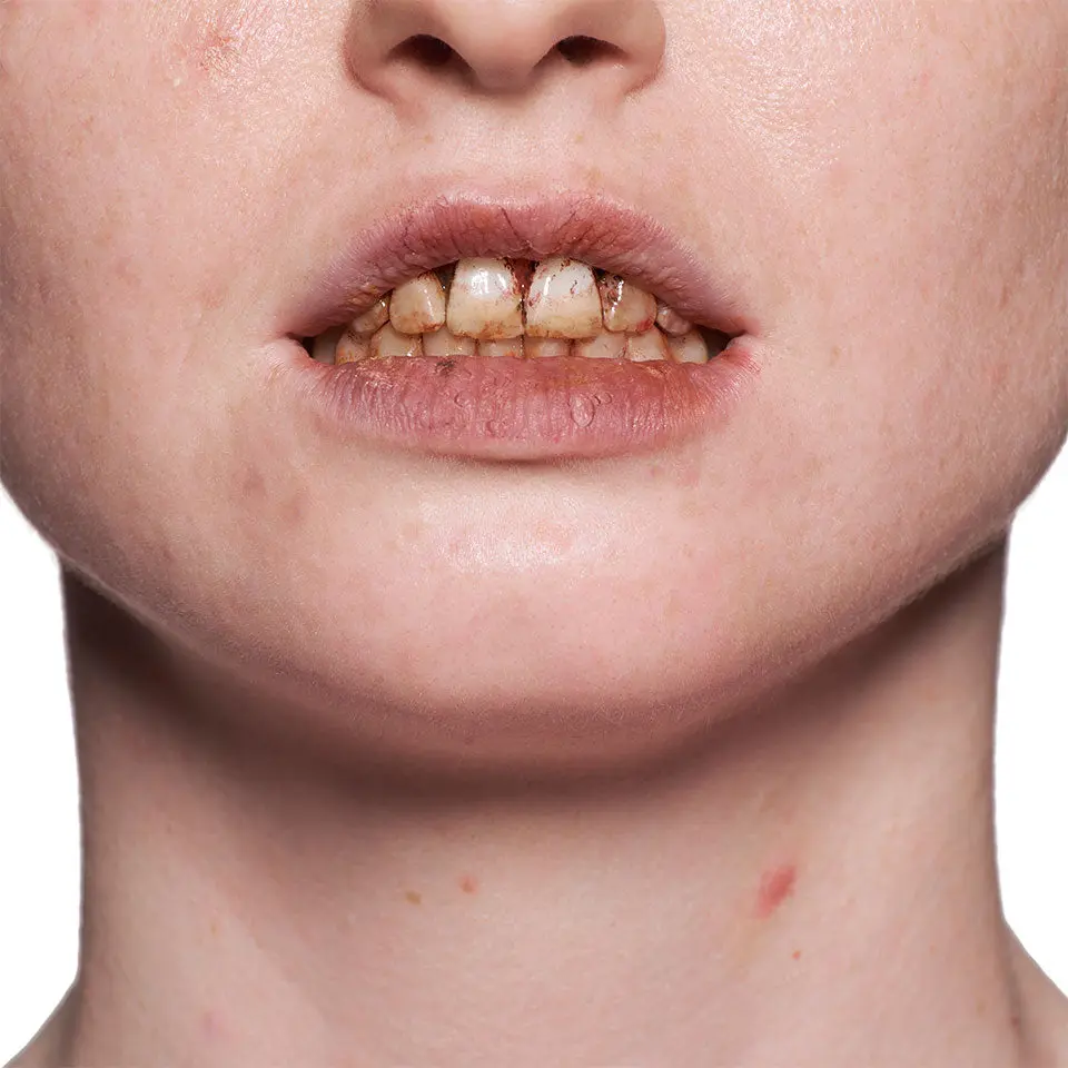 Tooth Enamel Red - Image 2