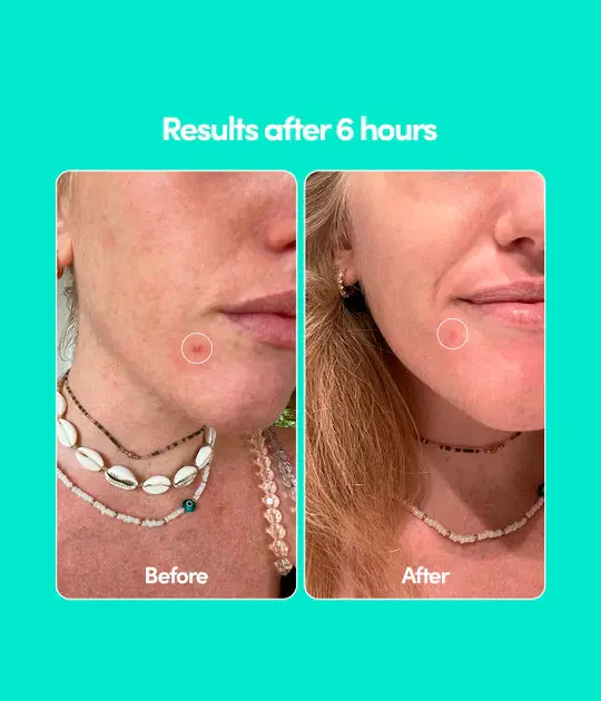 Pimple Patches - Image 2
