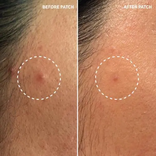 Hydrocolloid Invisible Pimple Patches - Image 2