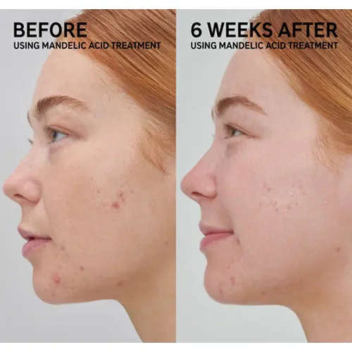 Mandelic Acid Treatment - Image 2