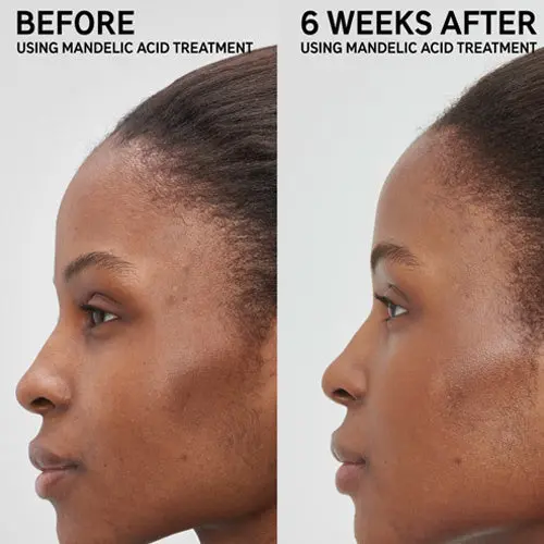 Mandelic Acid Treatment - Image 3