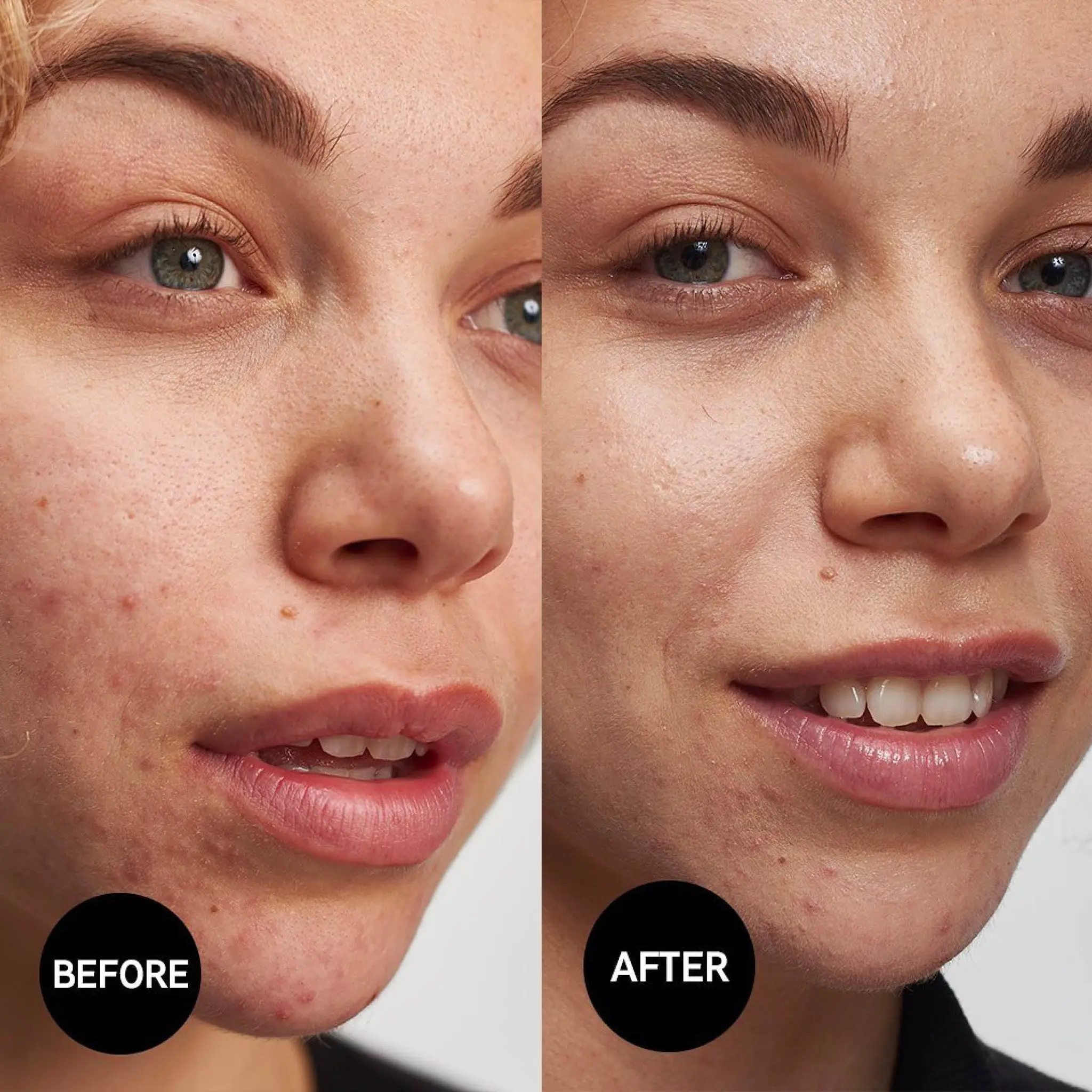 Salicylic Acid Cleanser - Image 2
